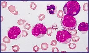En las neoplasias, el concepto de diferenciación se refiere al grado de especialización de las células cancerosas.