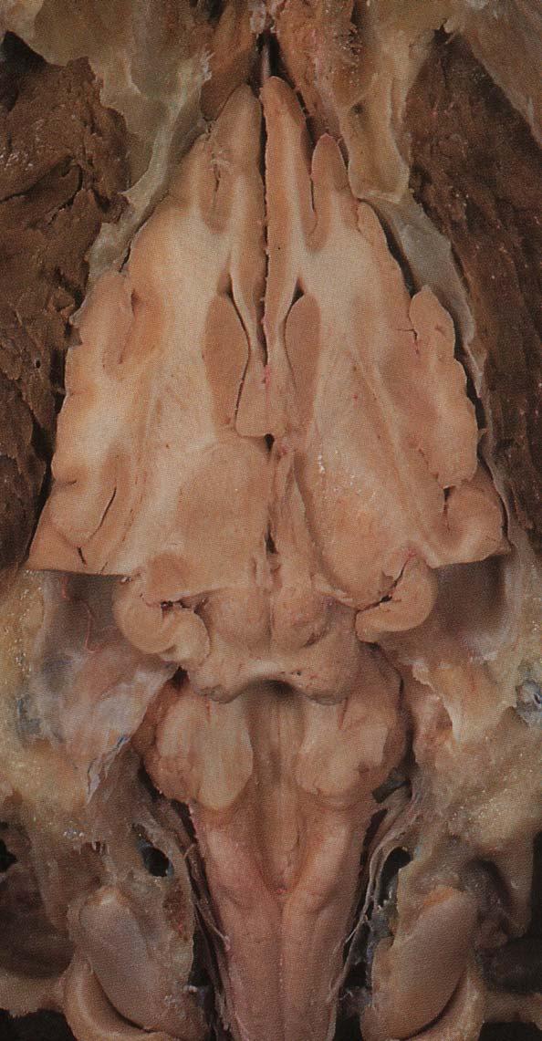 MIELENCÉFALO VISTA DORSAL Piso del cuarto ventrículo, mitad caudal (fosa romboídea) Pedúnculo cerebeloso caudal