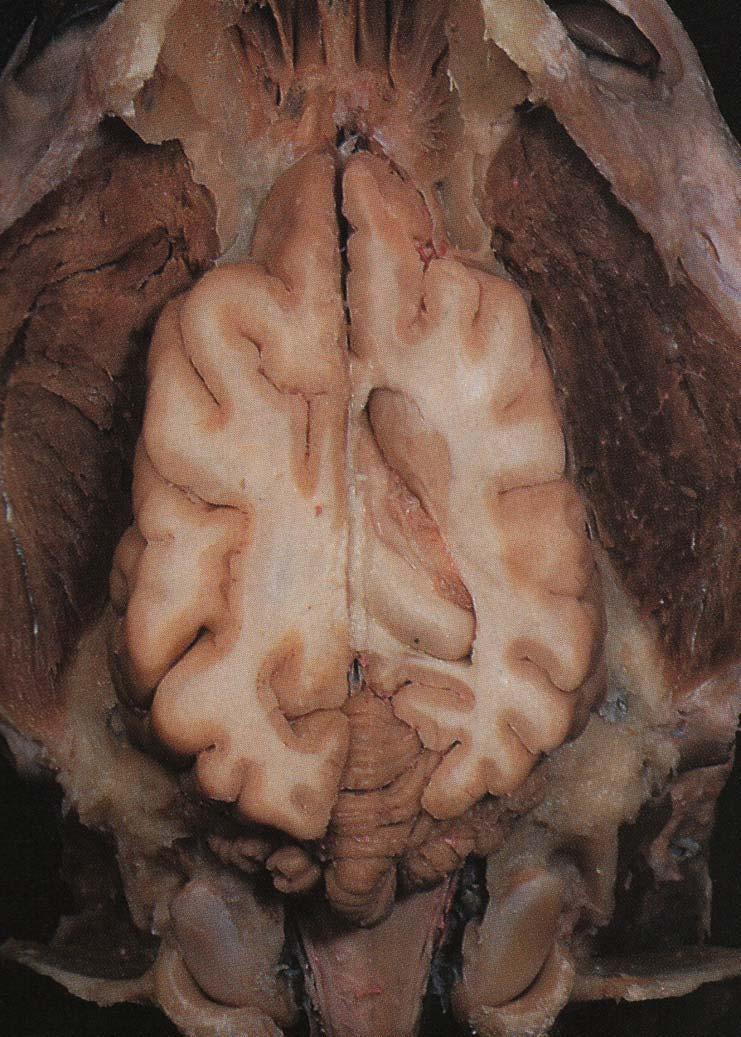 Telencéfalo Cerebro II- Cuerpo estriado: núcleos basales - Relación con corteza motora, tálamo, subtálamo, n rojo y s.