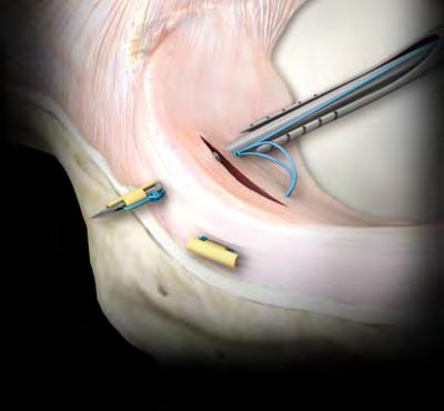 Técnicas de sutura: All inside: Elección