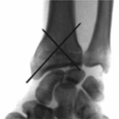 Evaluación clinico-radiológica de fracturas distales de radio Figura 1. Imagen radiológica de la técnica descrita por Clancey.
