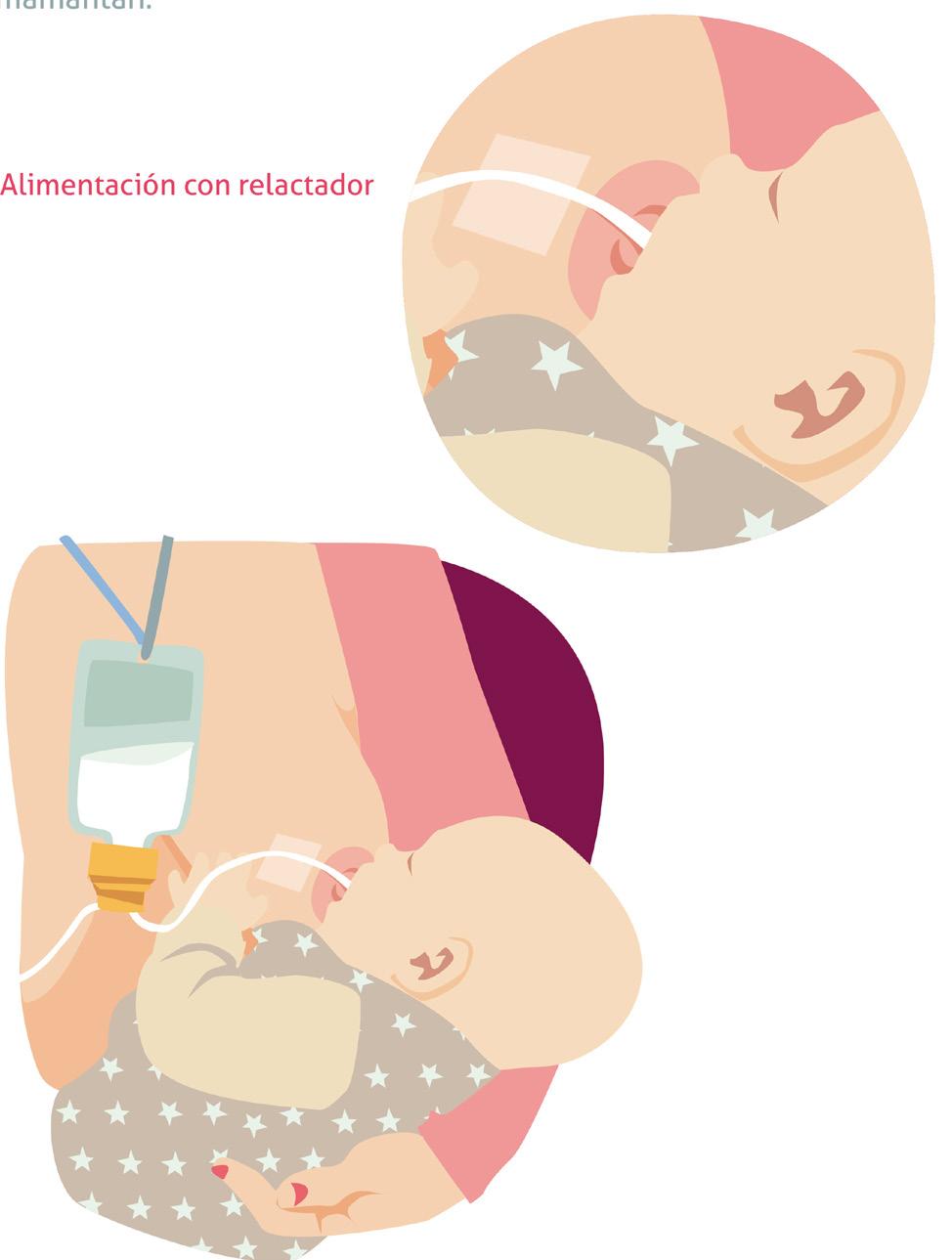 Alimentación con relactador El relactador es un dispositivo que permite que el bebé reciba suplementos de leche materna extraída o leche artificial mientras succiona del pecho.