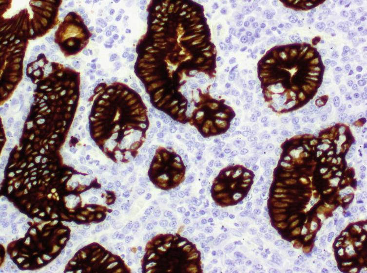 pequeño tamaño y núcleo discretamente irregular, pudiendo observarse algunos linfocitos grandes transformados.