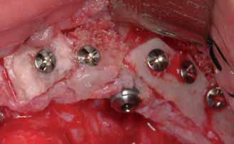 se colocan cinco implantes Astra Tech en las localizaciones previstas en el estudio tomográfico.