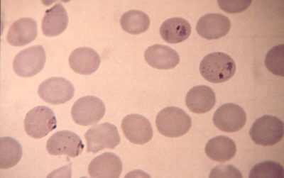 P. falciparum Aspecto de los eritrocitos: Tamaño normal o disminuído Gl.