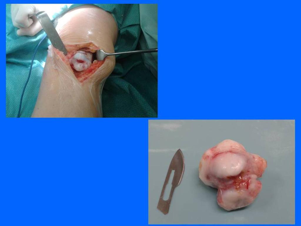Fig. 5: Acto quirúrgico donde se realiza tumorectomia.