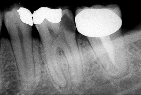 PRINCIPIOS, REGLAS Y REQUISITOS PARA REALIZAR UNA CORRECTA CAVIDAD DE ACCESO CORONAL: 1) Conocimiento previo de la anatomía dental. 2) Estudio radiográfico previo del diente.