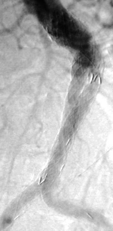 Ten-year outcomes after endovascular aneurysm repair (EVAR) and magnitude of additional procedures.