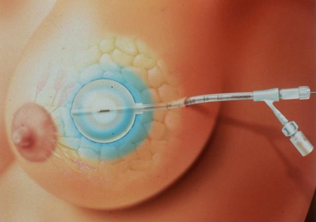 MammoSite device (Proxima, Cytyc, Hologic) Inflatable Balloon Placed In Lumpectomy Cavity At Surgery HDR