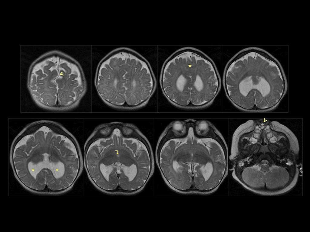 Fig. 7: RM cerebral secuencia T2 en planos axiales secuenciales: holoprosencefalia semilobar con presencia de dos hemisferios cerebrales hipoplásicos y fusionados en su aspecto anterior (estrella).