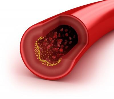 Colesterol y riesgo cardiovascular 10/03/2016 El colesterol es una sustancia grasa natural presente en todas las células del cuerpo humano necesaria para el normal funcionamiento del organismo.