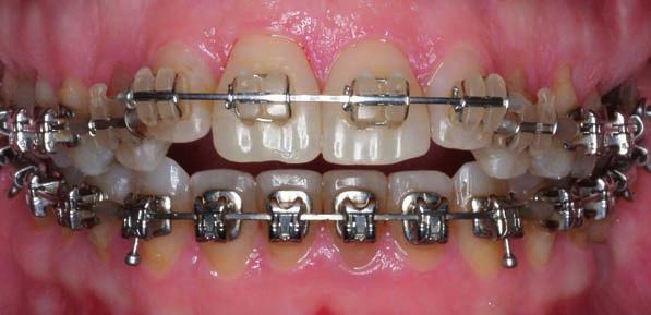 ortodoncia superior
