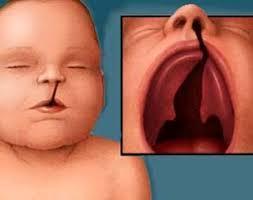 desarrollo fetal El paladar hendido se produce cuando el paladar no se
