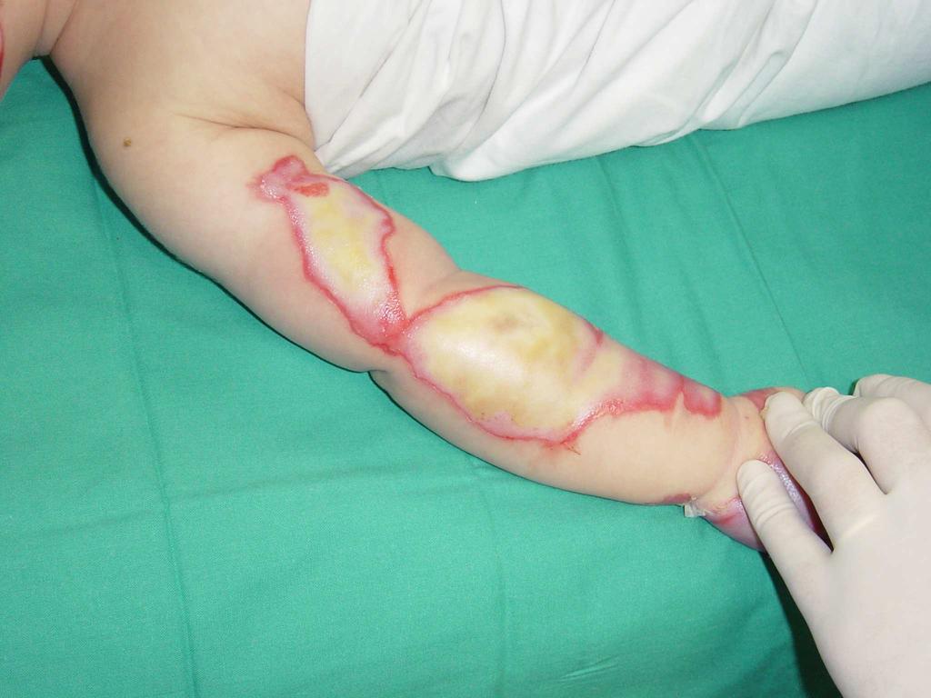 Profilaxis de hemorragia digestiva alta Atención a la quemadura VALORACIÓN Extensión: Regla palma mano 1% Tabla de Lund-Browder Profundidad I