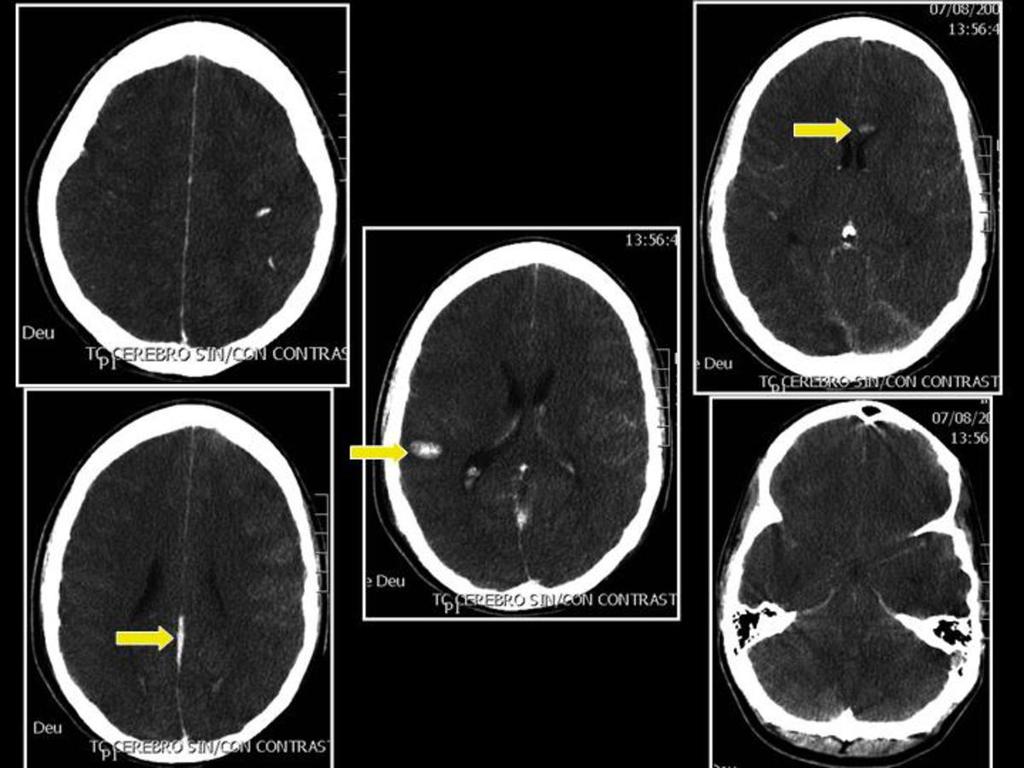 Fig. 10: TC cerebral: Edema cerebral difuso, con pérdida de la diferenciación entre sustancia blanca y gris, borramiento de los surcos y de las cisternas basales.