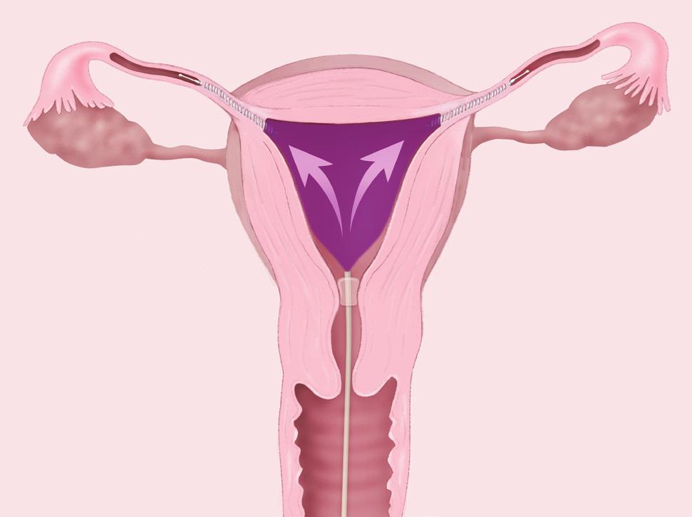 Tintura en el útero, que muestra las trompas totalmente bloqueadas. Insertos Essure Trompa de falopio Ovario Útero Cuello del útero Vagina Cómo funciona la prueba?