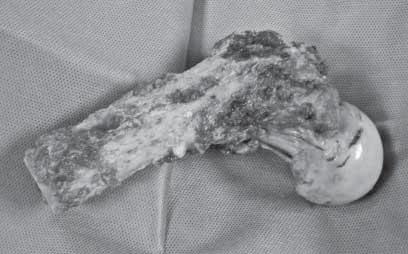 Fresado de canal femoral hasta 12 mm, con rimas manuales, para la colocación de vástago femoral de prótesis femoral no convencional (Figura 6). 10.