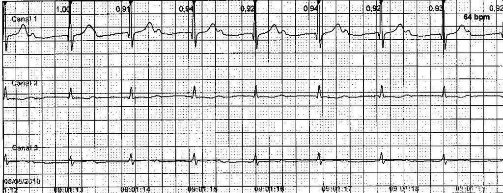 Llama la atención en el Holter que por momentos la conducción AV 1:1 es a través de un intervalo PR extremadamente prolongado (440mseg) (Figura 2) que alterna con un intervalo PR basal de (240mseg).