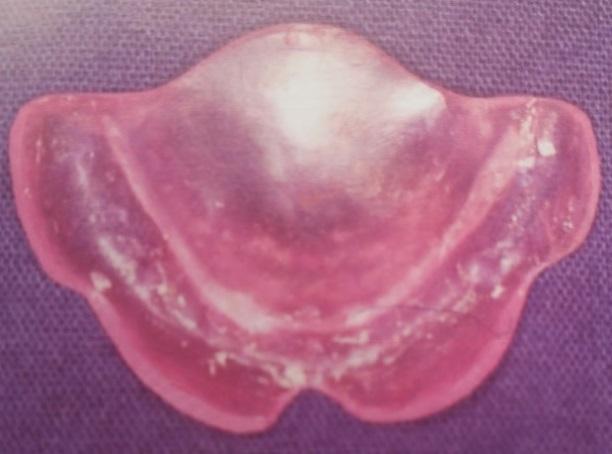 sus ventajas inmunológicas, nutricionales y afectivas, hasta tanto se realicen las cirugías correspondientes a la fisura labial en una primera etapa y posteriormente la alvéolo- palatina.