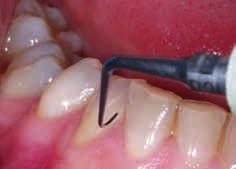 Mantenimiento periodontal Periodoncia Ref. F00090 P2L Ref.