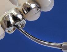 Utilizar la extremidad plana del instrumento sujetándola con firmeza contra el diente.