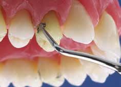 Eliminación de la estructura dental hipermineralizada.