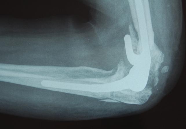 CASO 2 Paciente de 49 años con artrosis postraumática avanzada tras fractura supraintracondilea del humero