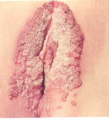 Condilomas HPV 6 y 11 responsables >90% of verrugas