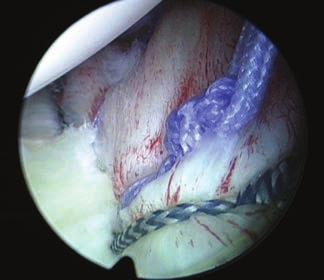 La sutura monofilamento es utilizada como pasa-hilos para pasar una sutura no reabsorbible a través de los tejidos capsulares previamente penetrados.