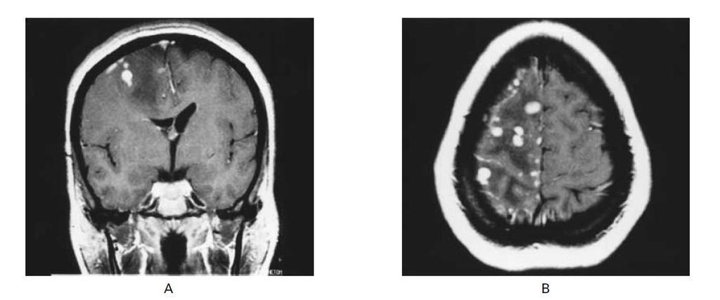 RMN de las lesiones Dos posibles patrones: Gummas cerebrales Masas circunscritas de densidad baja en T1 e isointensas o de densidad alta en T2