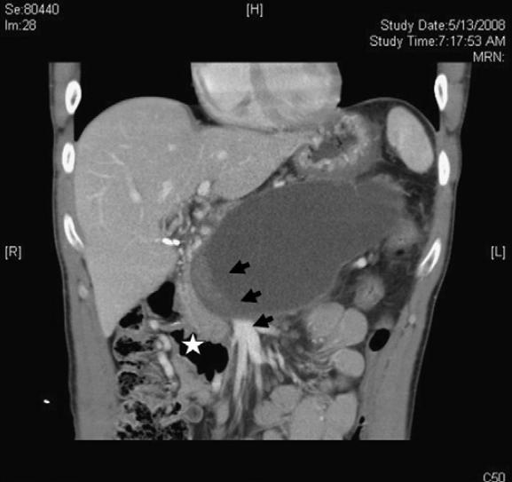 Pancreatitis Severe Aguda/TAC Mostrando >70% necrosis