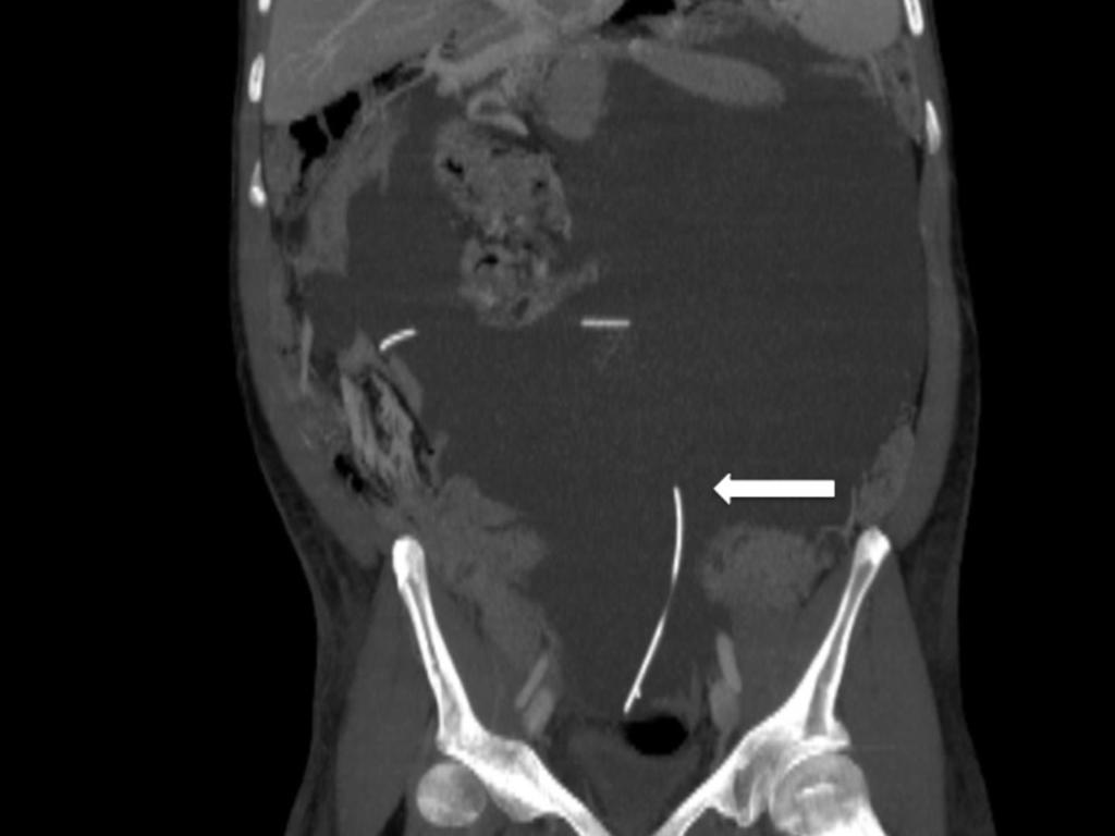 Fig. 12: Paciente con pseudoquiste gigante que muestra el desplazamiento de las asas intestinales y la porción intraquística del catéter