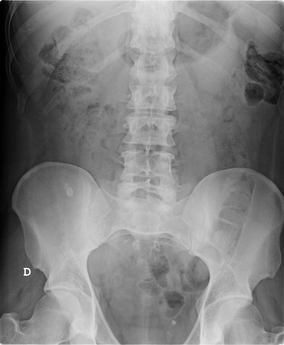 Fig. 1: Asa apendicular engrosada (6,4 mm), edematosa, (visión longitudinal y axial), en paciente con clínica de dolor epigástrico que posteriormente se centra en FID. Fig.