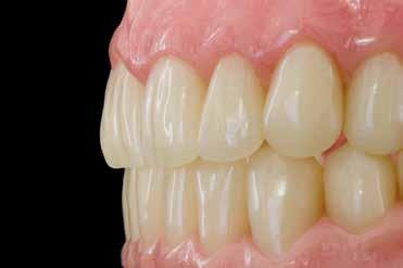 Ventajas: Funcional: Los dientes anteriores AcrySmart permiten una total individualización de las dinámicas funcionales manteniendo una estética superior.
