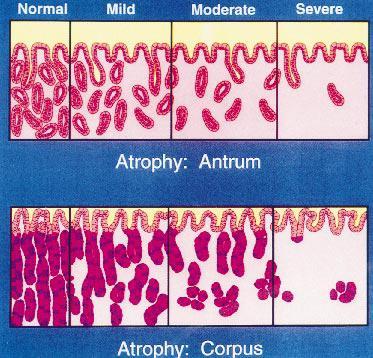 DISPLASIA: en la gastritis crónica de larga evolución, el epitelio desarrolla alteraciones citológicas, entre ellas, variación del tamaño, forma y orientación de las células epiteliales;