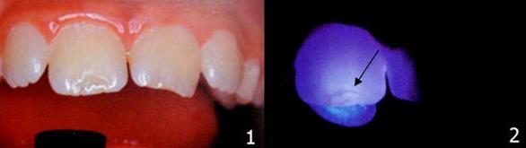 TRATAMIENTO Control radiográfico Remoción de bordes agudos del esmalte Restauración Protección con Dycal de la dentina expuesta y colocación del ionomero (5) FIGURA 4: HALLAZGOS CLÍNICOS DE UNA