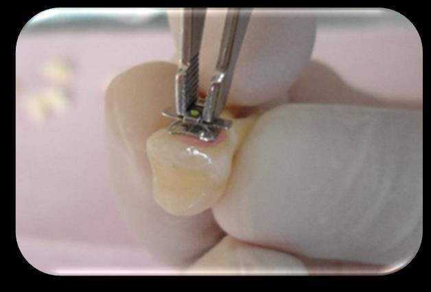 Posteriormente, se colocó el adhesivo Transbond MIP sobre la superficie bucal del diente
