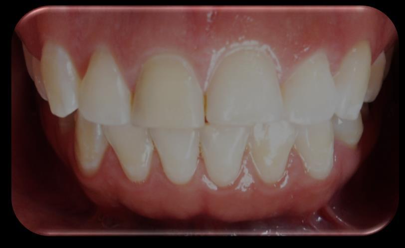 desde la conexión amelodentinaria (CAD) hasta la superficie externa o libre en contacto con el medio bucal. (Fig.1) Fig. 1. Esmalte Dental. Fuente directa.