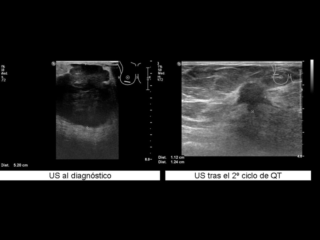 Fig. 10: La imagen de la izquierda muestra la US al diagnóstico, donde la masa presentaba un diámetro de 5.2 cm.