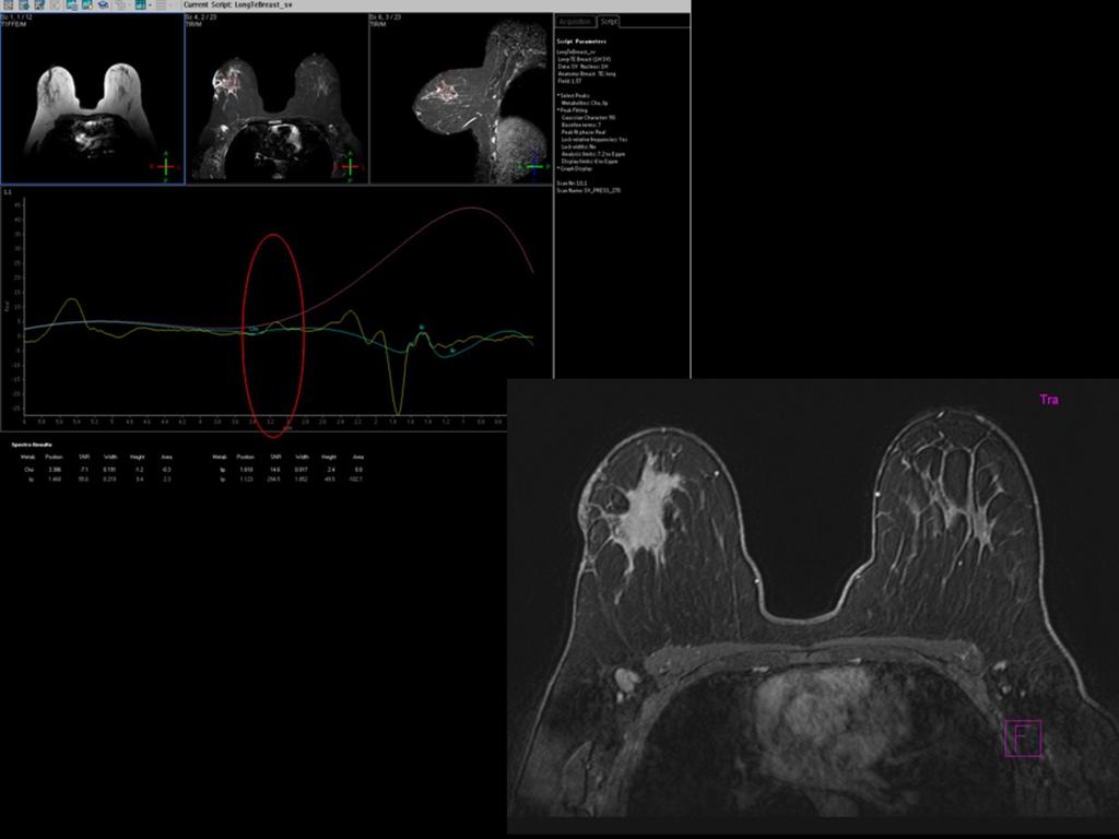 Fig. 2: A la izquierda se muestra la RM espectroscopia en el estudio inicial, que muestra un pequeño pico tumoral de colina.