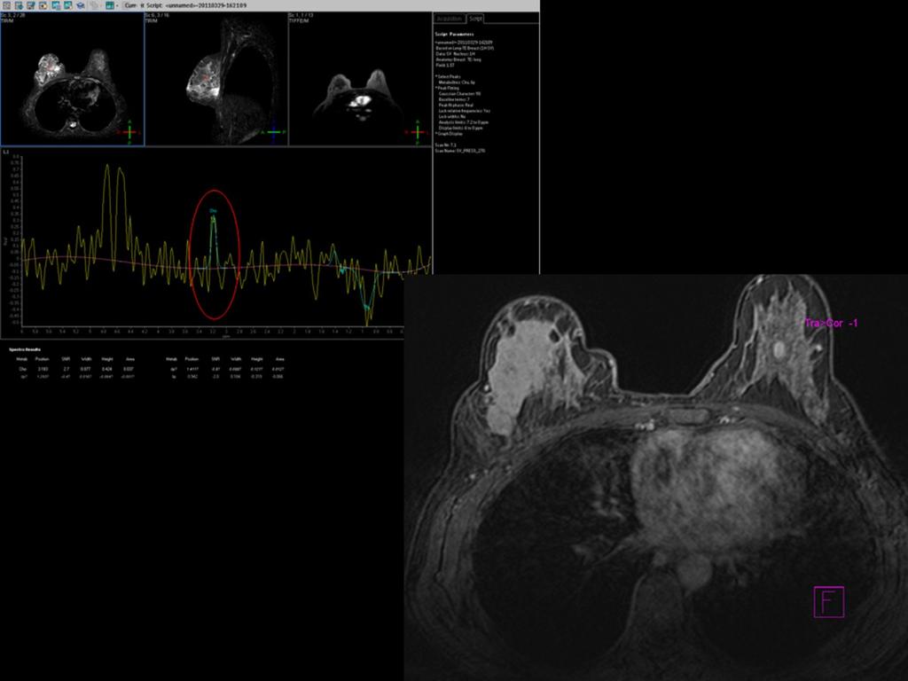 Fig. 4: A la izquierda se muestra la RM espectroscopia en el estudio inicial, que muestra un importante pico tumoral de colina.