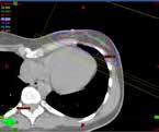 SDX es un sistema basado en la espirometría para manejar el movimiento del tumor torácico y abdominal durante la imagen y la radioterapia.