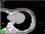 imagen y visualización de los tumores 4 Reducción de los márgenes de tratamiento 6-8 Aumento de la dosis con menor toxicidad para los órganos vitales 8-10 Reposicionamiento de los órganos vitales
