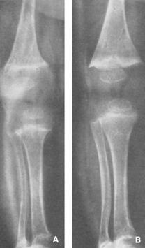 Manifestaciones radiológicas Los cambios metafisiarios son más evidentes en los huesos con un mayor crecimiento Curvaturas de los huesos y fracturas a distintos niveles Densidad ósea disminuida y