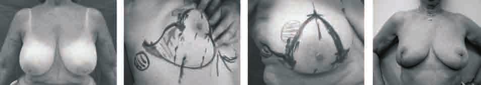 58 Figura 2. Técnica de Mc Kissock. Tumor de cuadrante superior externo de mama derecha de 5 cm. Resección con margen oncológico y vaciamiento axilar.