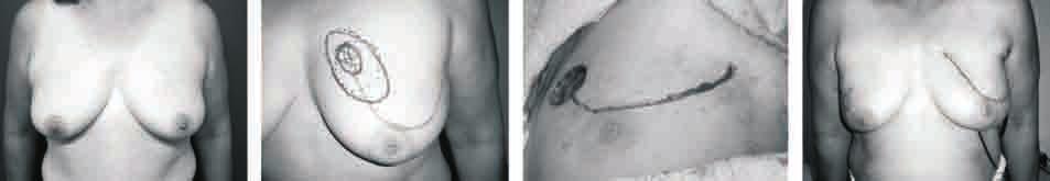 60 Figura 5. Flap rotatorio local. Tumor de cuadrante superior interno de mama izquierda. Resección con margen oncológico resecando piel y vaciamiento axilar.