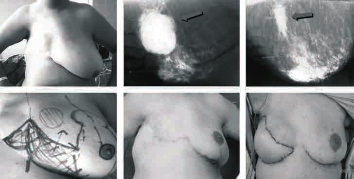 6 Figura 7. Mastoplastia sin neoareola. Tumor de cuadrante superior interno de mama izquierda de 8 9 cm. Quimioterapia de inducción con respuesta total clínica y mayor mamográfica.