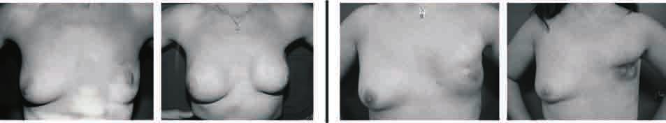 63 COMPLICACIONES RM inmediata (n=72) RM diferida (n=0) Otra mama Hematoma Infección Retraso de la cicatrización Seroma mamario Seroma axilar Seroma de dorso Contractura capsular severa (Baker 3/4)
