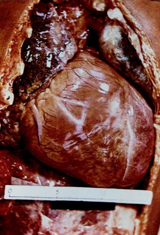 Cardiomegalia Crecimiento ventricular