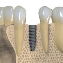 Posición coronoapical del implante Los implantes dentales Straumann permiten la colocación coronoapical flexible del implante, dependiendo de la anatomía individual del paciente, de la ubicación del